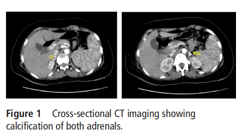 Cross-sectional CT imaging showing  calcification of both adrenals.